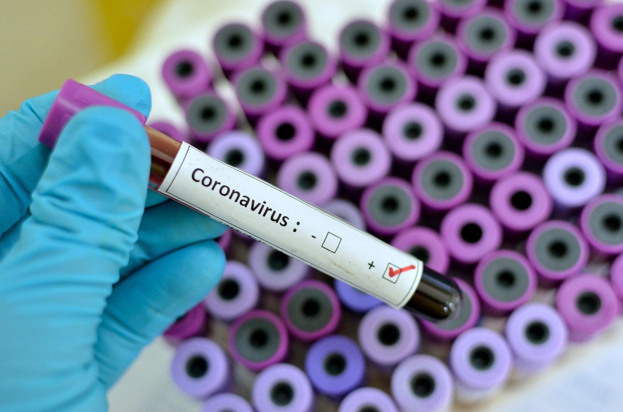 Salud Pública reporta dos muertes y 385 nuevos casos en las últimas 24 horas por coronavirus
